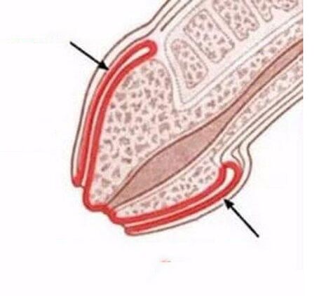 Penis inflammation