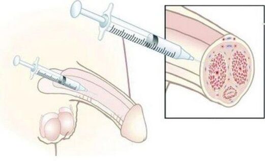 Hyaluronic acid injections housing